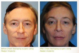 cheek implant before after pictures