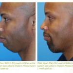 chin implant before after photos