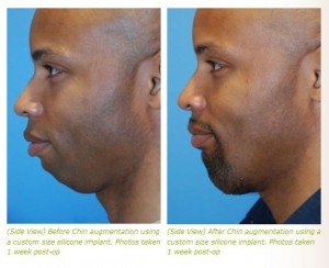 chin implant before after photos