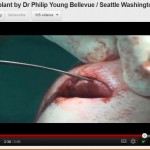 chin implant video