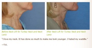 neck lift before after images