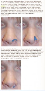 nostril alar rim lowering rhinoplasty