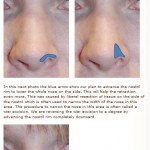 nostril alar rim lowering rhinoplasty