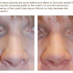 rhinoplasty alar rim lowering of the nostril rim before and after