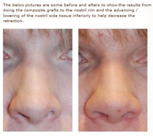 rhinoplasty alar rim lowering of the nostril rim before and after