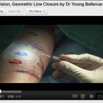 scar treatment geometric line closure video