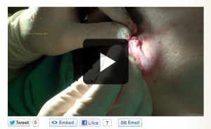 earlobe gauging repair video