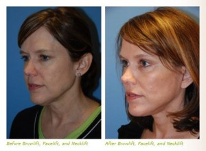 lateral brow lift before after images
