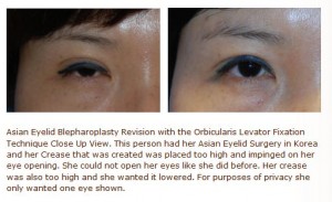 revision asian double eyelid surgery