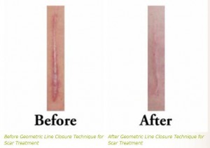 sca rtreatment geometric line closure