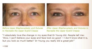 upper eyelid lift blepharoplasty