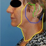 Facelift-figure-8-Different-Variations-of-the-Face-Lift-Dr-Young-Bellevue-Washington-150×150