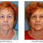 facelift-before-after-image