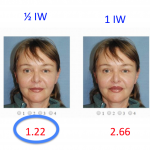 Morphed Real Life Pictures: Upper Lip was Found to Be Ideally 1/2 Iris Width in Height