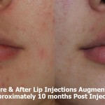 lip-augmentation-before-after-filler-enhancement